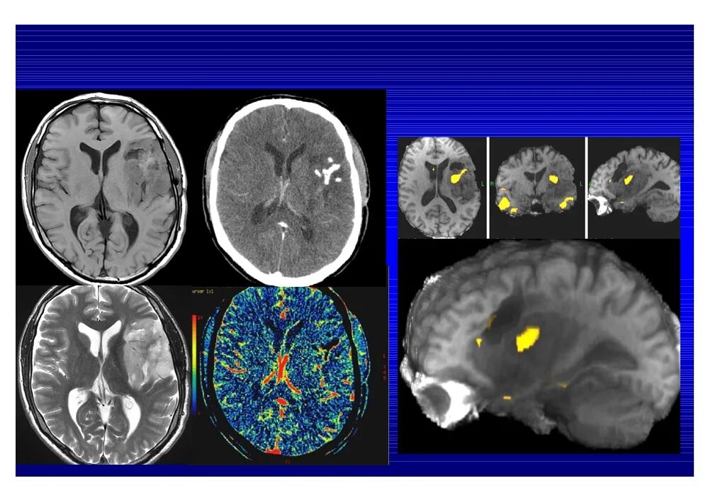 Опухоль мозолистого тела головного мозга. Глиома височной доли кт. Опухоль мозга височной доли симптомы. Опухоли височной доли головного мозга клиника. Опухоли мозга у подростков