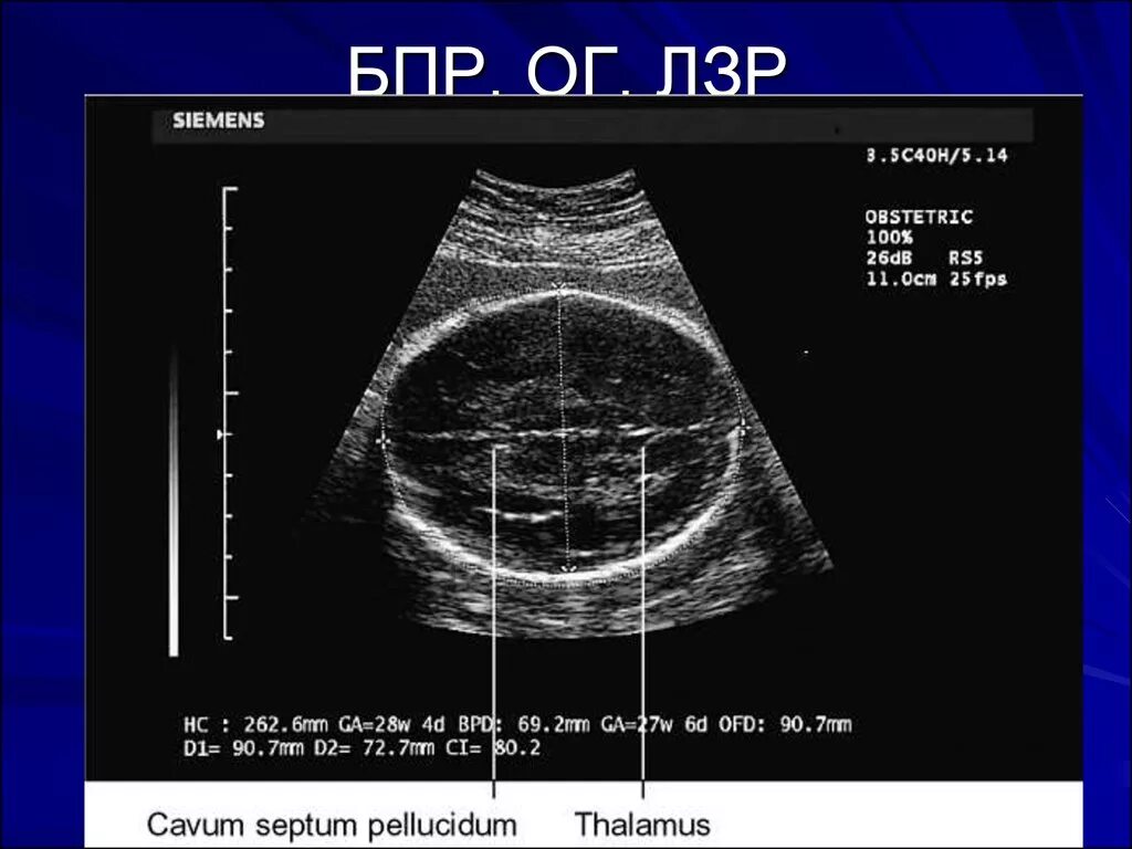 БПР/ЛЗР норма. Бипариетальный размер (БПР, BPD). Бипариетальный размер головки. БПР ЛЗР плода. Окружность головы плода