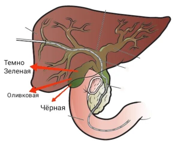 Катетер желчного пузыря