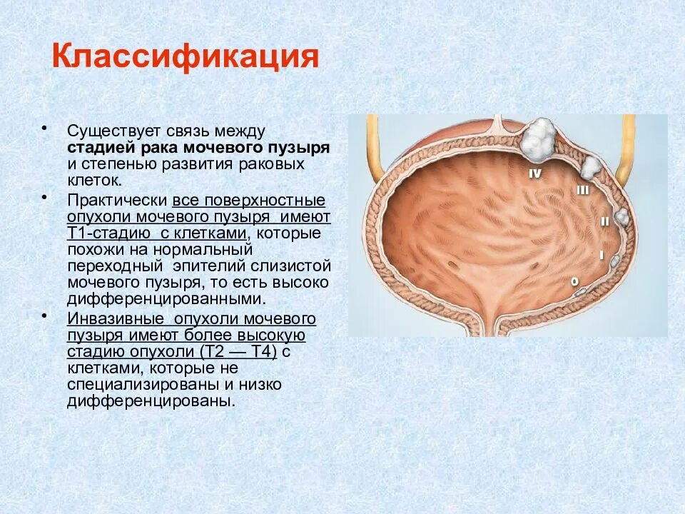 Рак мочевого сколько живут