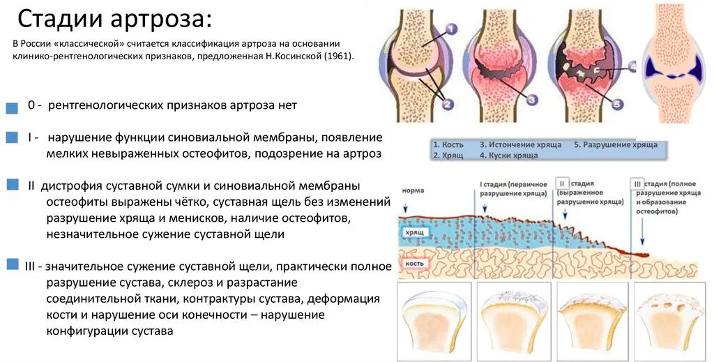 Артроз какие степени