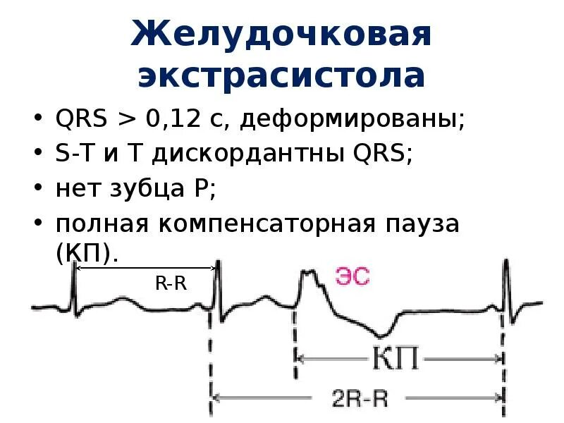 Сколько экстрасистол норма