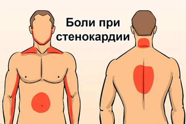 Боль при стенокардии. Локализация боли при стенокардии. Иррадиация боли при стенокардии. Локализация боли в сердце.