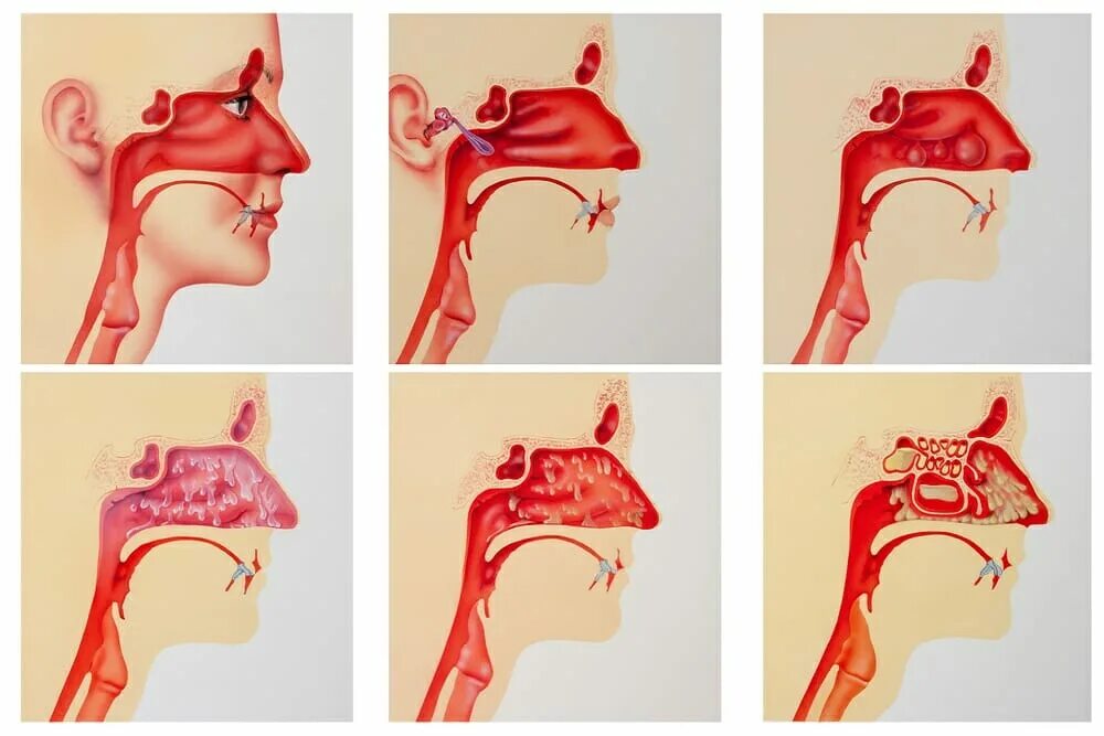 Кровоточивая зона полости носа. Сосуды в носу. Сосуды в носу. Сосуды в носу. Артерии кровоснабжающие нос.