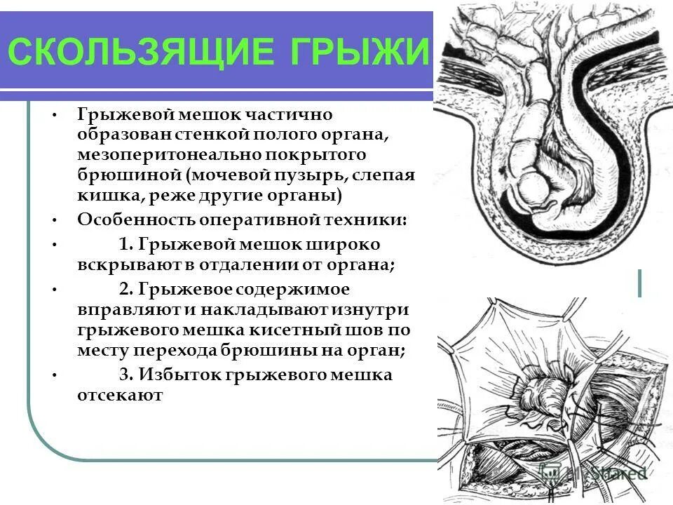 Стенка грыжевого мешка