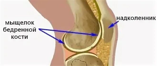 Отек мыщелка бедренной. Боль под коленной чашечкой. Болит под коленной чашечкой спереди. Отек костного мозга надколенника. Костный мозг надколенника.