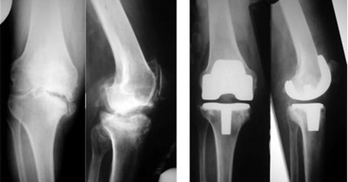 Эндопротезирование коленного рентген. Эндопротез коленного сустава рентген. Артроз коленного сустава эндопротез. Деформирующий артроз коленного сустава рентген.