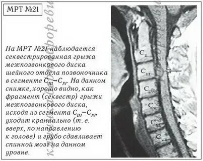 Лечение секвестрированной грыжи без операции