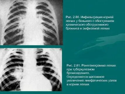 Синдром инфильтрации легких