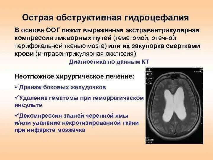 Выраженная заместительная гидроцефалия. Наружная гидроцефалия головного мозга кт. Внутренняя обструктивная гидроцефалия. Острая обструктивная гидроцефалия. Обтурационная гидроцефалия.