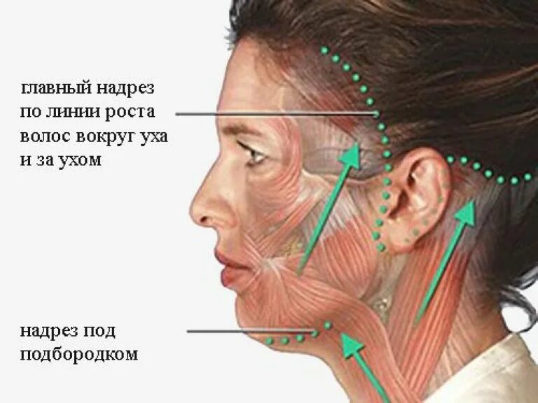 Круговая подтяжка лица схема. Разрезы при круговой подтяжке лица. Швы при круговой подтяжке лица. Круговая подтяжка лица фото.