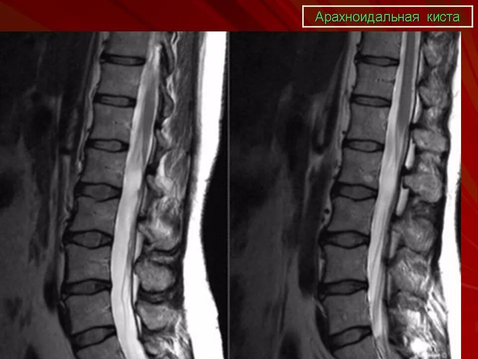 Периневральная киста l1-l2. Периневральная киста крестца s3. Периневральная киста l3 позвонка. Периневральные кисты s2 s3. Киста в пояснице
