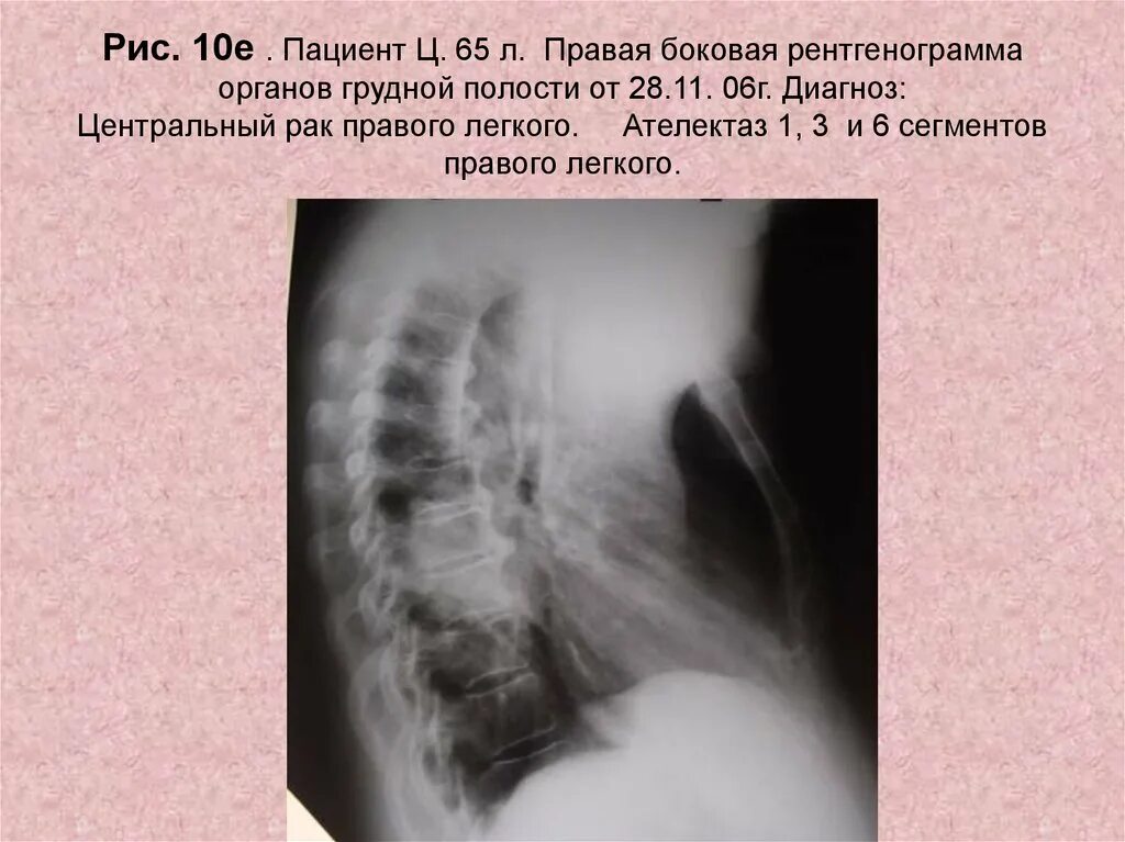 Центральный рак правого. Боковая рентгенограмма. Ателектаз легкого рентгенограмма. Рентгенограмма боковая проекция ателектаз. Боковая рентгенограмма легких.