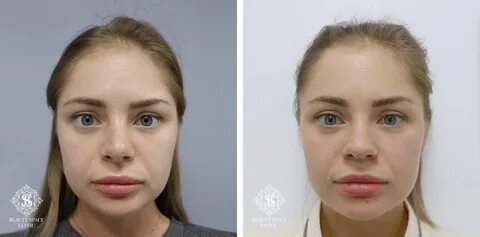 Ринопластика surgery kai angel