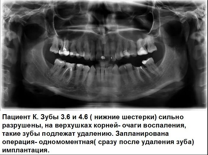 Вырывание шестерки зуб. Зуб шестерка на нижней челюсти.