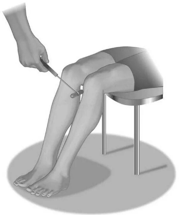 Колено стучит. Коленный сухожильный рефлекс. Невролог коленный рефлекс. Молоточком по коленке. Гипорефлексия коленного рефлекса.