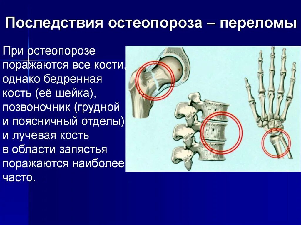 Переломы при остеопорозе. Осложнения при остеопорозе. Остеопоретические переломы. Остеопороз последствия. Последствия трещины