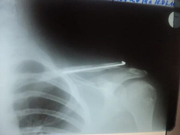 Остеосинтез акромиально-ключичного сочленения. Многооскольчатый перелом ключицы. Перелом ключицы у ребенка снимок. Периимплантный перелом ключицы. Перелом ключицы с допустимой смещением.