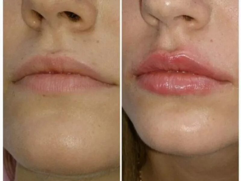 Губы в мл сколько стоит. Увеличение губ Juvederm Ultra smile 0.55. Коррекция губ Ювидерм Смайл. Ювидерм филлер 0.5 мл для губ.