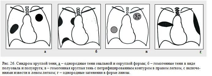 Округлыми формами в легком. Синдром круглой тени рентген. Синдром круглой тени в легочном поле. Синдром круглой тени рентгенологические синдромы. Синдромы легкихруглой тени.