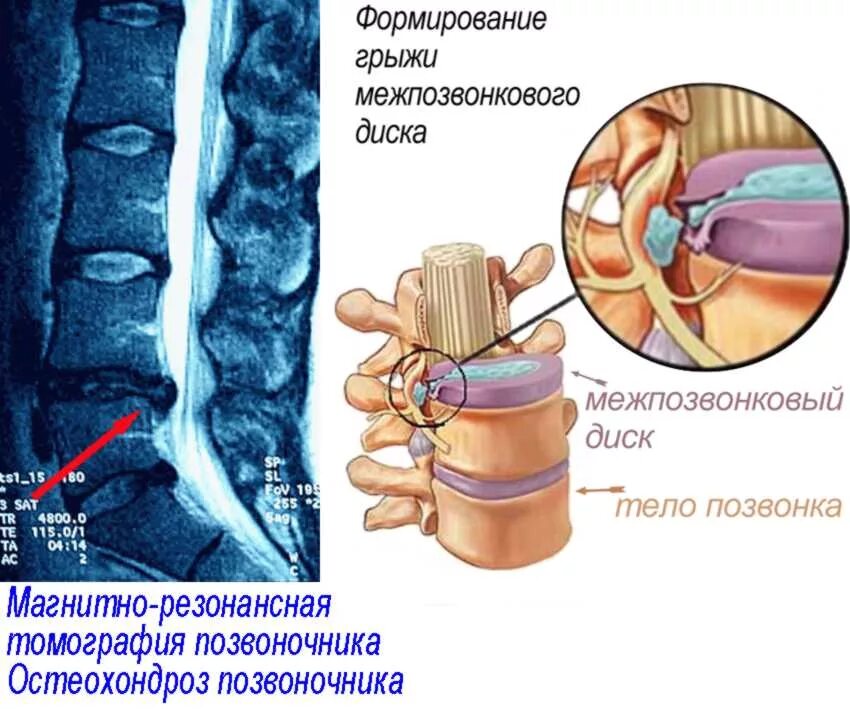 Межпозвонковая грыжа поясничного отдела лечение. Остеохондроз шейного отдела грыжа межпозвоночного диска. Грыжи дисков поясничного отдела позвоночника. Межпозвонковые грыжи поясничного отдела. Грыжа позвонка поясничного отдела.