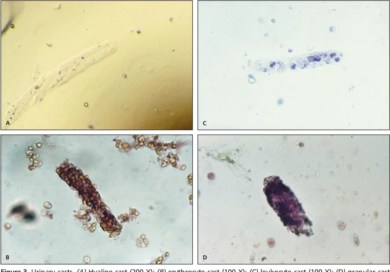 Повышенные цилиндры в моче. Цилиндры в моче. Цилиндры в моче под микроскопом. Эритроцитарные цилиндры в моче. Зернистые цилиндры в моче.