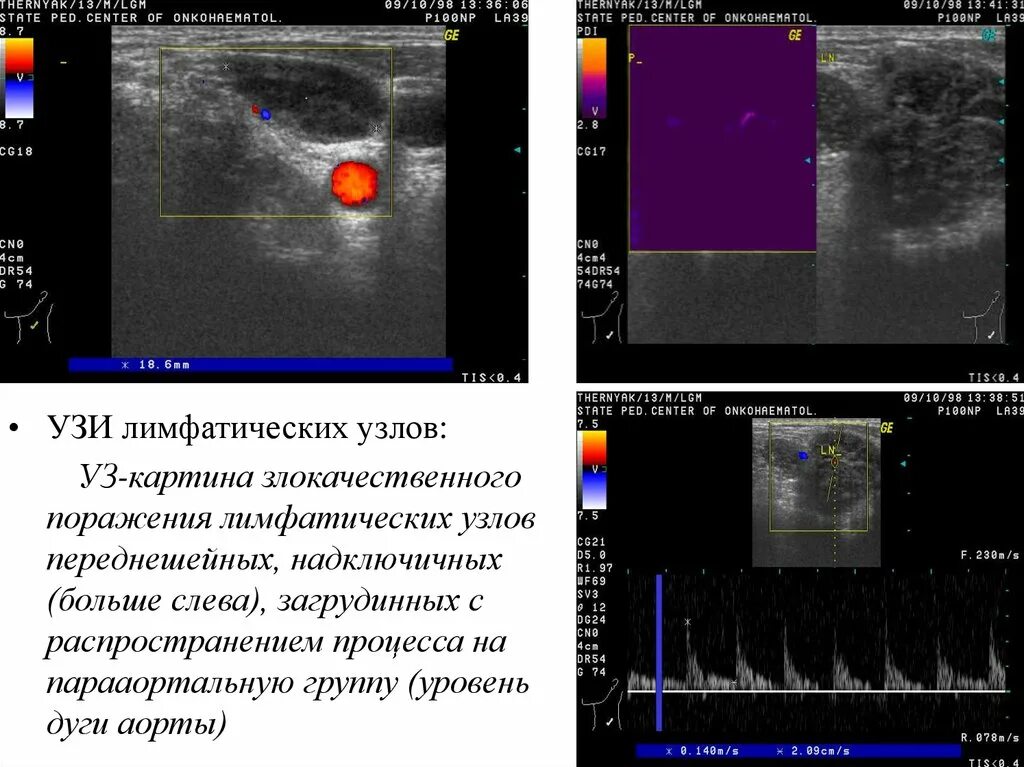 Строение лимфатического узла на УЗИ. УЗИ лимфатических узлов норма. Патология лимфатических узлов на УЗИ. УЗИ заушных лимфатических узлов. Цдк лимфоузлов