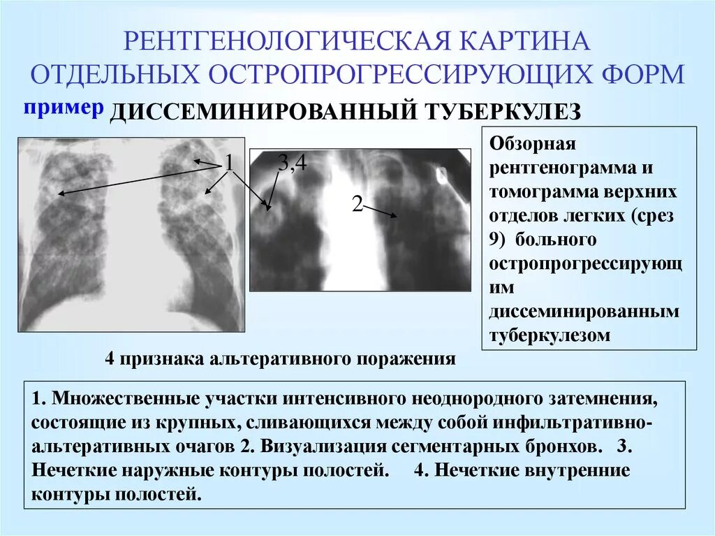 Диссеминированный туберкулез рентген описание. Рентгенологические синдромы при диссеминированном туберкулезе. Рентгенологические симптомы диссеминированного туберкулеза. Рентгенологическая картина диссеминированного туберкулеза легких.