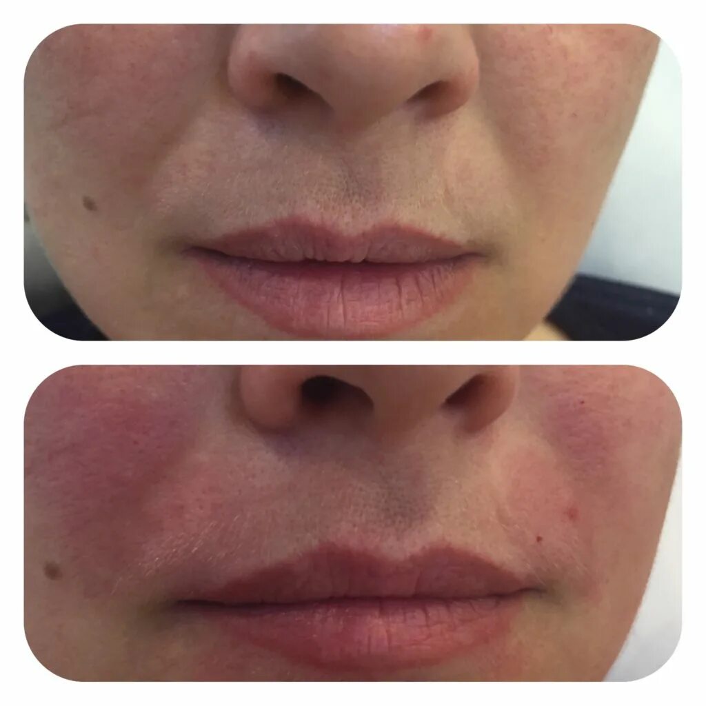 Контурная пластика носогубки. Носогубка гиалуроновая кислота. Носогубки гиалуроновой кислотой. Контурная пластика носогубки. Гилоурон в носогубные складки.