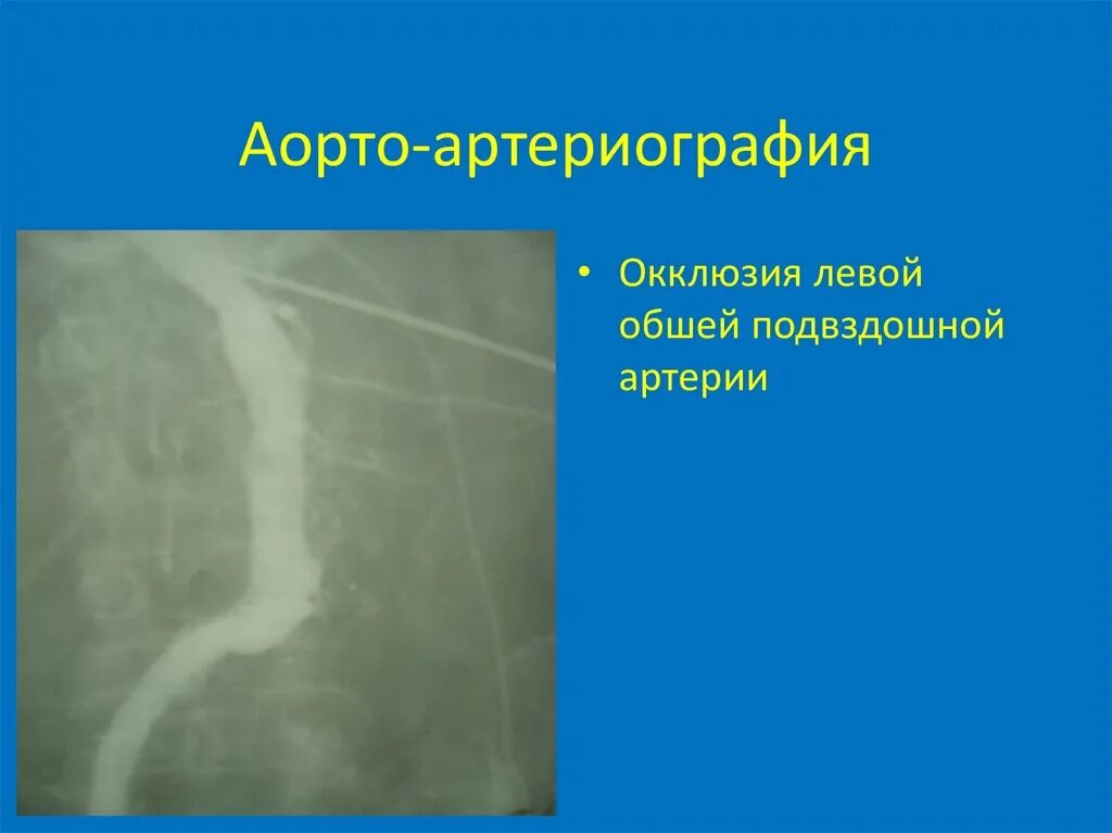 Аортоартериография нижних конечностей. Окклюзия левой подвздошной артерии. Острая артериальная непроходимость. Острая артериальная ишемия