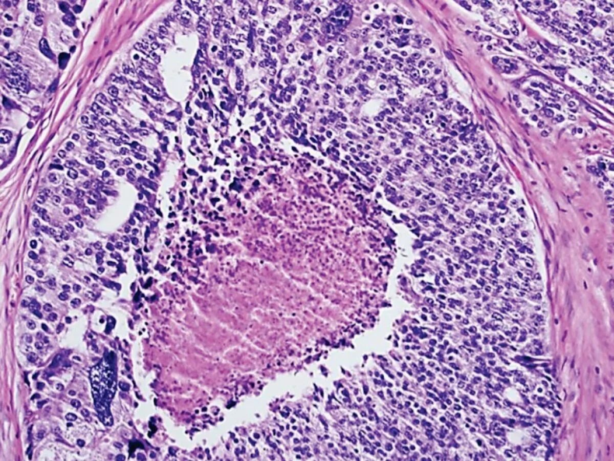 Простата поперечный срез гистология. Простатическая железа гистология препарат. Мелкоацинарная аденокарцинома гистология. Гиперплазия аденомы простаты. Предстательная железа норма гистология.