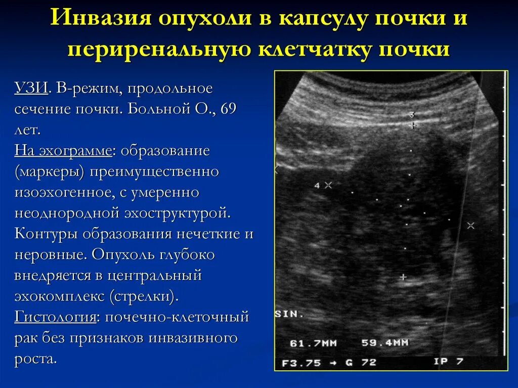 Объемное образование почки. Объемное образование в почке на УЗИ что это.