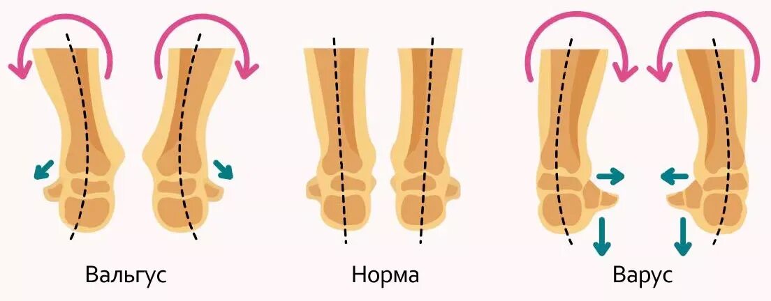 Пятки внутрь. Вальгусная и варусная деформация. Вальгус Варус плоскостопие. Плоско варусная деформация стоп.