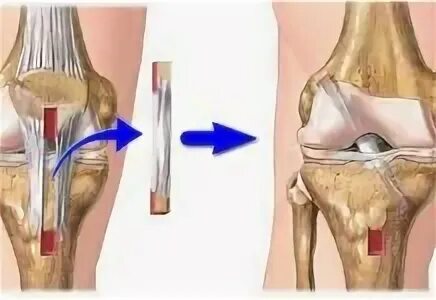 Операция колено пкс. Операция на крестообразной связки коленного сустава. Пластика MPFL коленного сустава. Пластика ПКС коленного сустава. Задняя крестообразная связка коленного сустава анатомия.