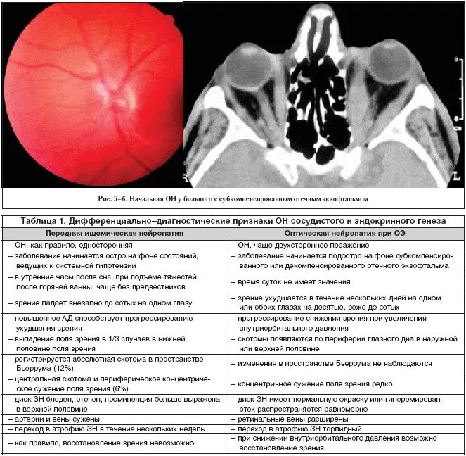 Дифференциальная диагностика передней ишемической нейропатии. Ишемическая оптическая нейропатия дифференциальная диагностика. Задняя ишемическая оптическая нейропатия. Нейрооптикопатия зрительного нерва. Нейропатия глаза