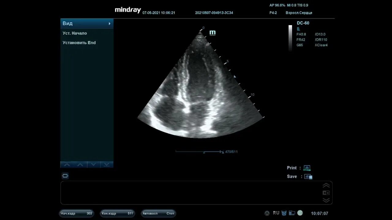 Узи щитовидной железы изранов. Узи щитовидной железы изранов. Узи сердца видеоурок изранов. Узи щитовидной железы протокол изранов. Лекции изранова по узи диагностике.