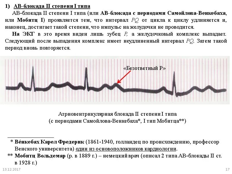 Блокада инструкция. AВ блокады 2 степени с периодами Самойлова Венкебаха. Атриовентрикулярная блокада II степени (Тип i Мобитца). Периоды Самойлова-Венкебаха на ЭКГ. АВ-блокада 2 степени с периодами Самойлова Венкебаха на ЭКГ.