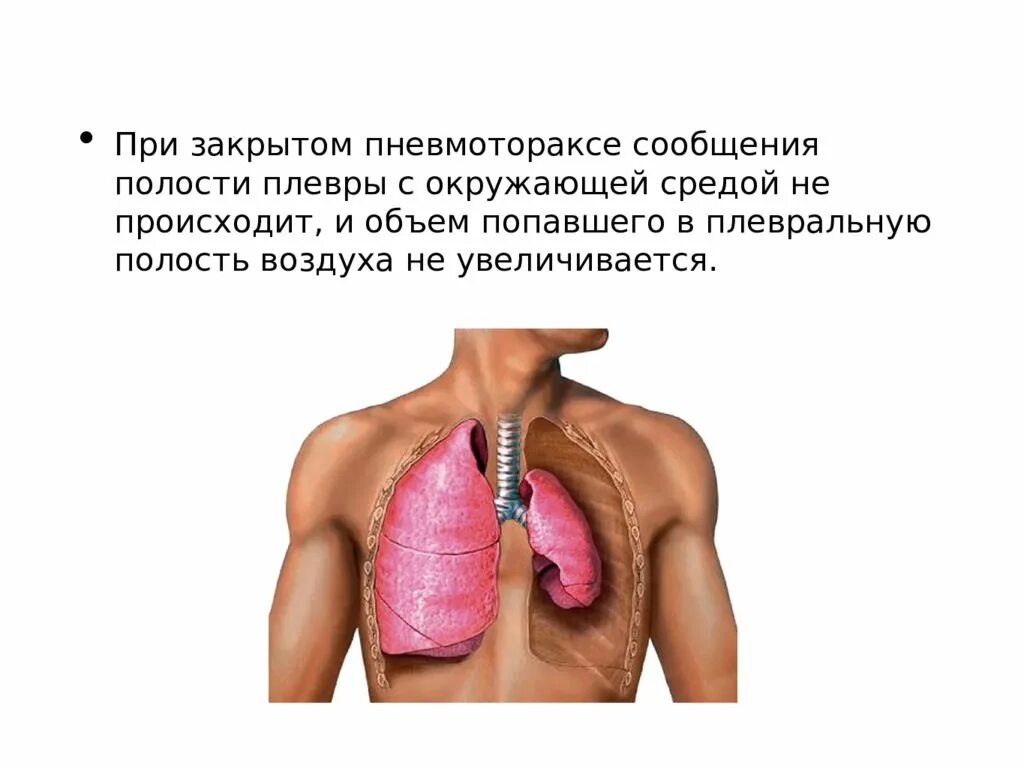 Спонтанный пневмоторакс. Локальный пневмоторакс. Диагностика закрытого пневмоторакса. Клапанный спонтанный пневмоторакс. Плевральная полость грудной клетки.