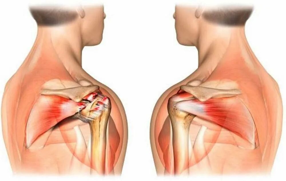 После операции болят плечи