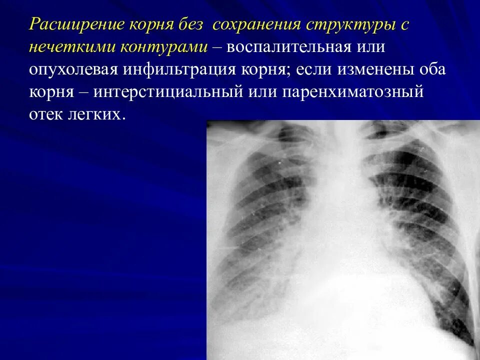 Отек легких рентген. Рентген картина отека легких. Интерстициальный отек легких рентген. Корни легких.