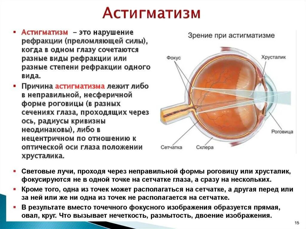 Как называется болезнь зрения. Аномалии рефракции глаза астигматизм. Рефракция нарушение рефракции. Сложный гиперметропический астигматизм 1 степени. Сложный миопический астигматизм левого глаза у ребенка.