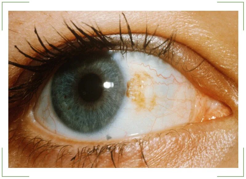 Конъюнктивит герпетический кератит. Мелькание мушек перед глазами. Глаза как будто пятно. Лимбальный кератоконъюнктивит. Глаза как будто пятно.