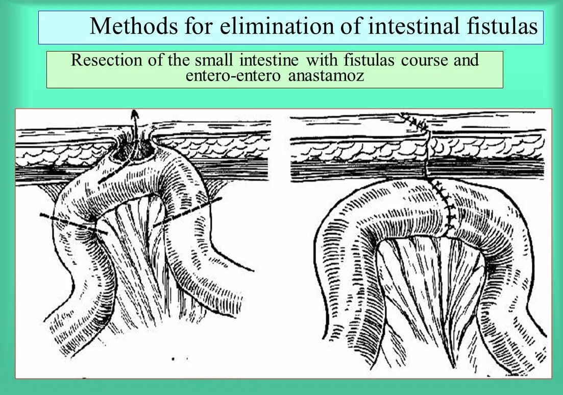 Ректальные операции. Эпителизированный свищ. Кишечные свищи Госпитальная хирургия. Толстокишечный лечебный свищ это.