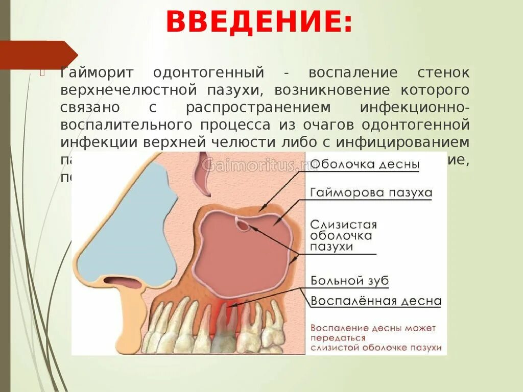 Одонтогенный гайморит верхнечелюстной пазухи. Одонтогенный синусит верхнечелюстной пазухи клиника. Острый одонтогенный верхнечелюстной синусит этиология. Катаральный одонтогенный гайморит.