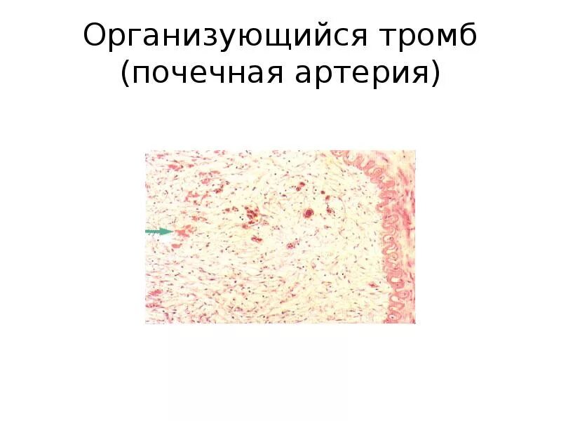 Тромб артерии микропрепарат. Тромбоз почечной артерии микропрепарат. Тромб микропрепарат