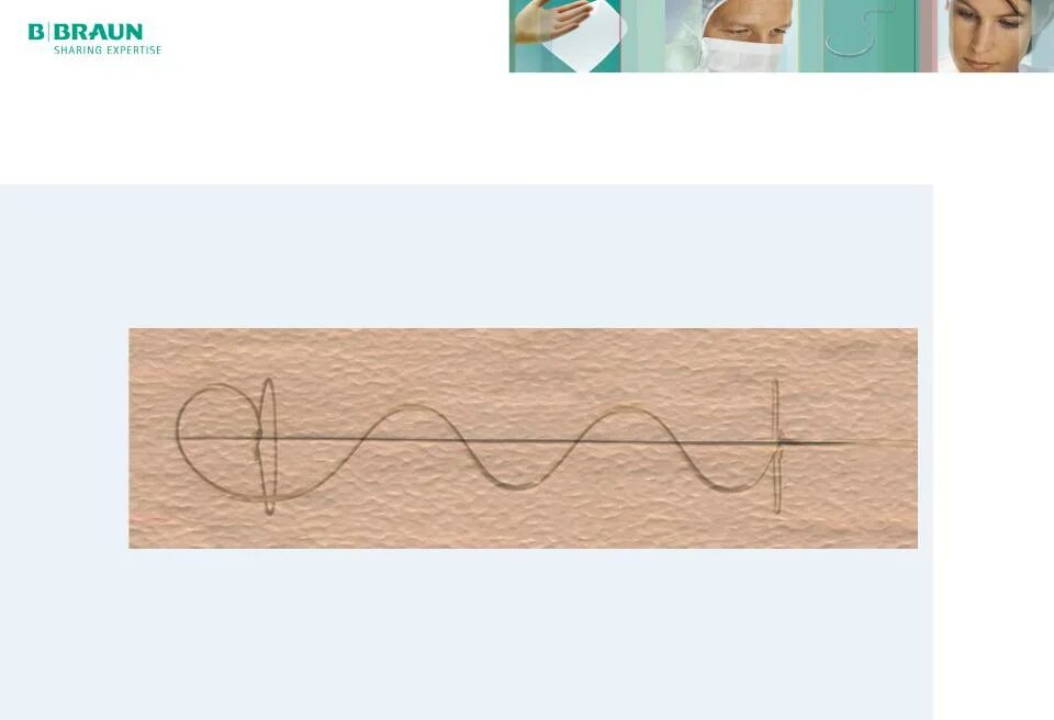 Silk suture - нитки рассасывающиеся ?. Внутрикожный шов рассасывается. Как выглядят рассасывающиеся швы. Как выглядят рассасывающиеся швы. Как выглядят рассасывающиеся швы.