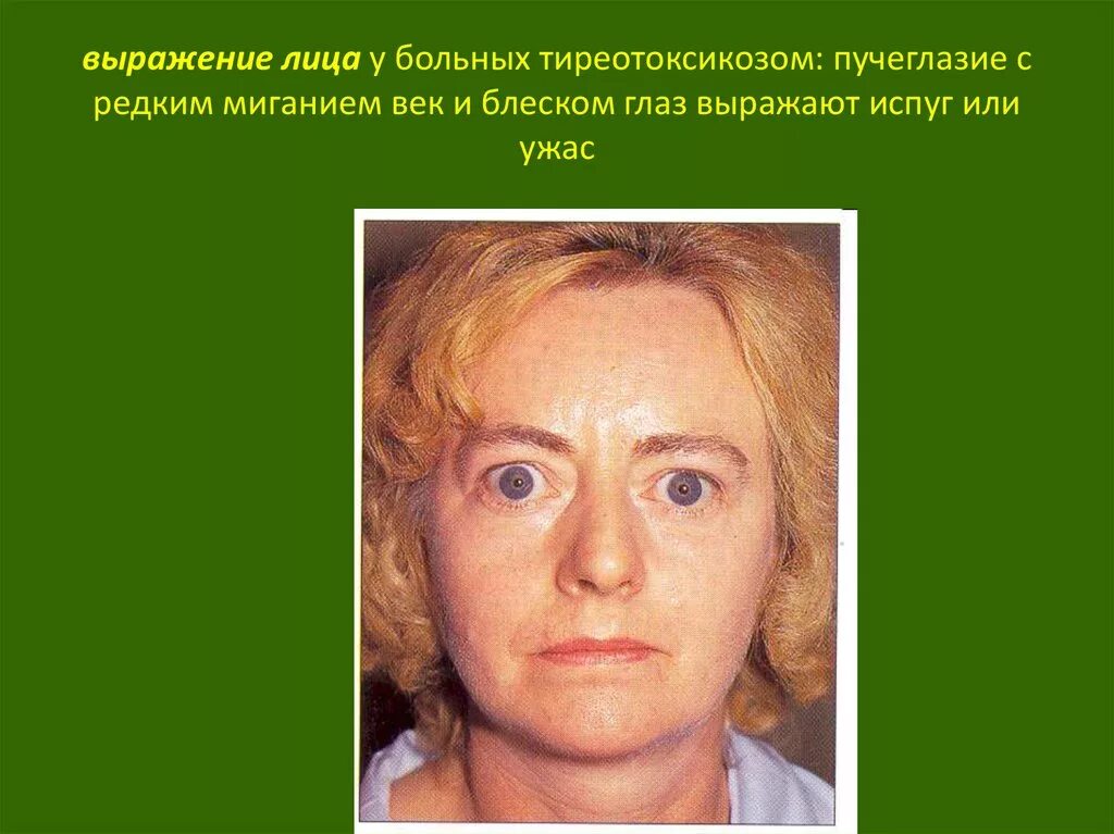 Гипотиреоз у пожилых. Гипотиреоз у пожилых людей. Гипотиреоз у пожилых. • гипотиреоз (микседема, кретинизм). Лицо больного гипертиреозом.