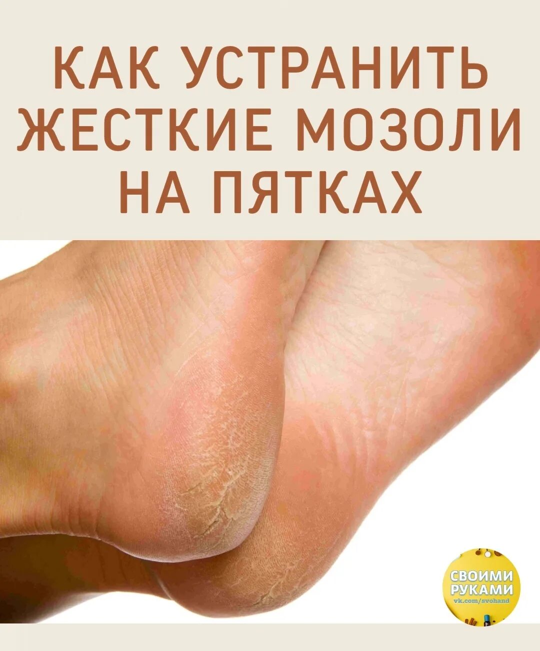 Как убрать натоптыши на пятках. Мозоли на пятках психосоматика. натоптыш на пяточной кости.