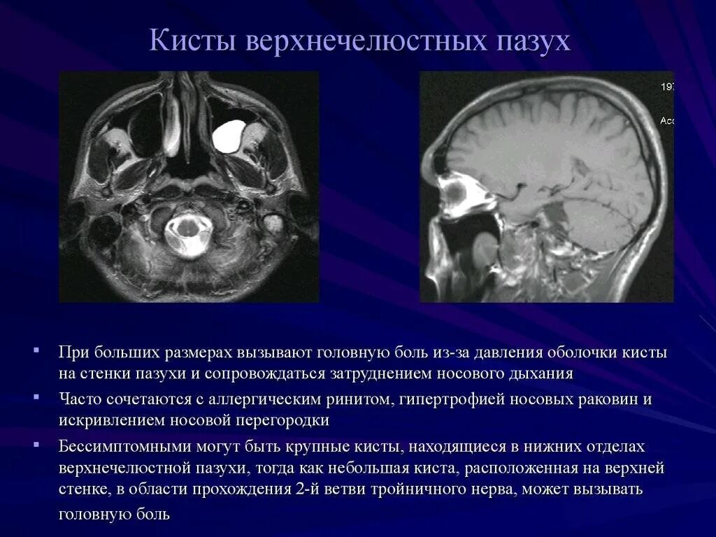 Признаки кистозных изменений. Киста левой левой верхнечелюстной пазухи. Ретенционные кисты верхнечелюстных пазух. Киста правой верхнечелюстной пазухи. Киста верхнечелюстной пазухи на кт.