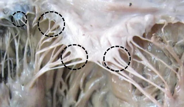 Хорда сердца опасно ли. Хорды клапанов сердца анатомия. Дополнительная продольная хорда левого желудочка. Хорда сердца опасно ли. Дополнительная хорда в сердце.